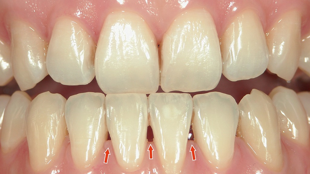 ブラックトライアングル