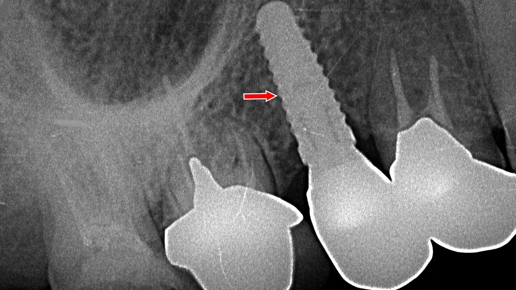 抜歯後の補綴治療｜上顎6番相当部インプラント上部構造装着後のX線所見