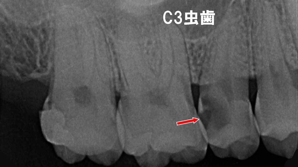 深部う蝕が原因で発症した歯髄炎（C3虫歯）