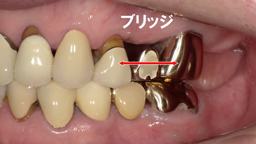 抜歯後に選ばれた自費ブリッジの実例