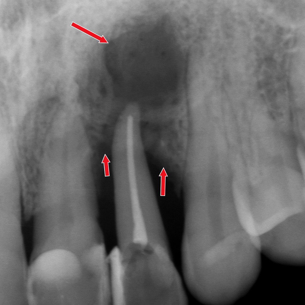 歯がグラグラする本当の理由：歯周病＋根尖病巣が同時に進行したケース