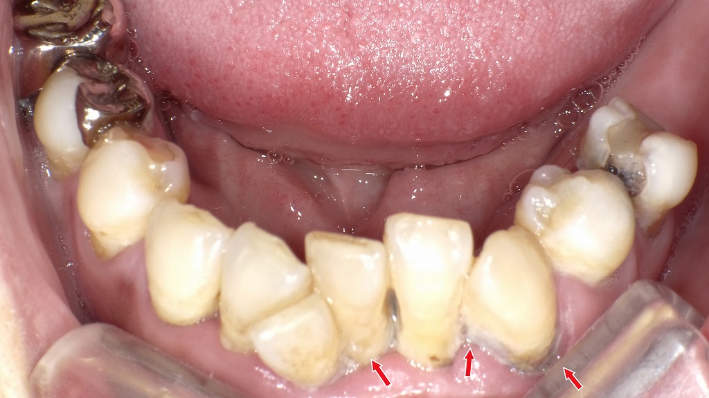 なぜ歯周病は誤嚥性肺炎を招きやすいのか――口腔内細菌の危険性