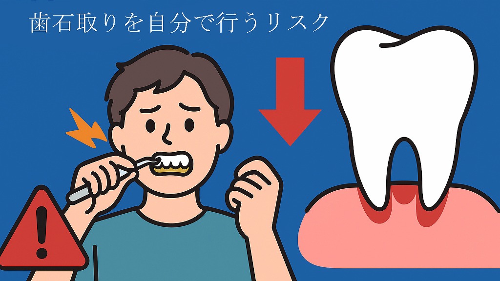 セルフ歯石除去のリスクと限界