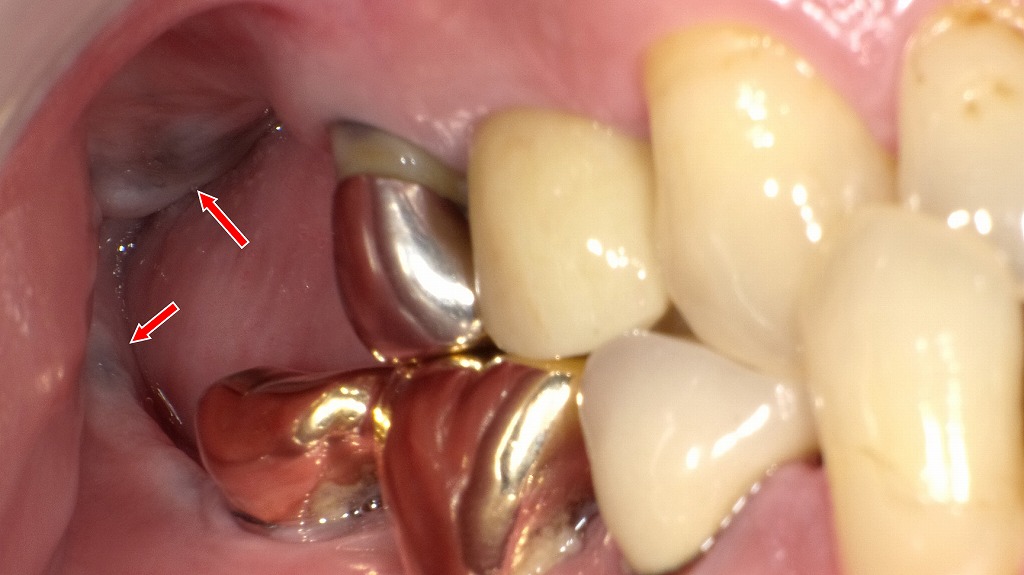 上下頬粘膜に出来た色素性母斑