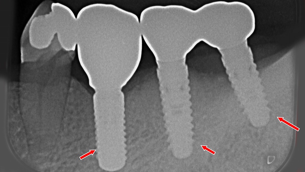 抜歯後に選択された下顎4・5・6番インプラント治療