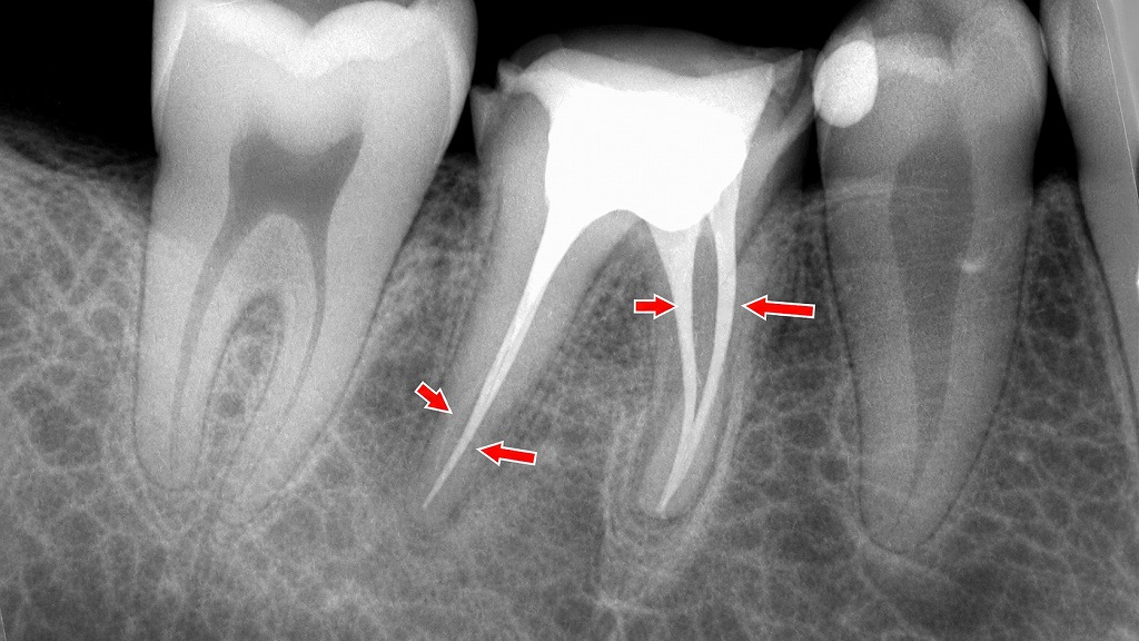 4根管の根管治療:根管充填が適正に完了したレントゲン像