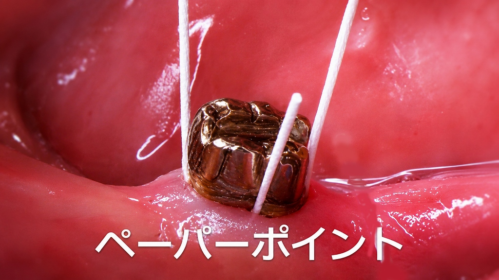 歯周ポケットから専用ペーパーポイントで検体採取