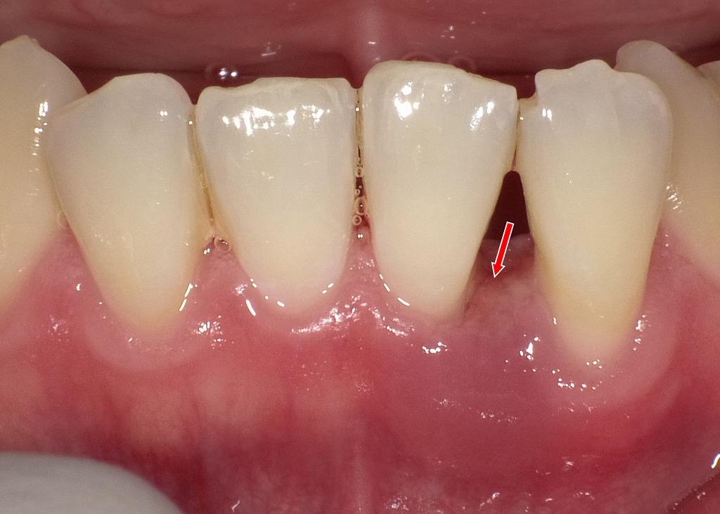 下顎前歯部の歯肉が下がり、垂直性骨欠損に対応する部位です。