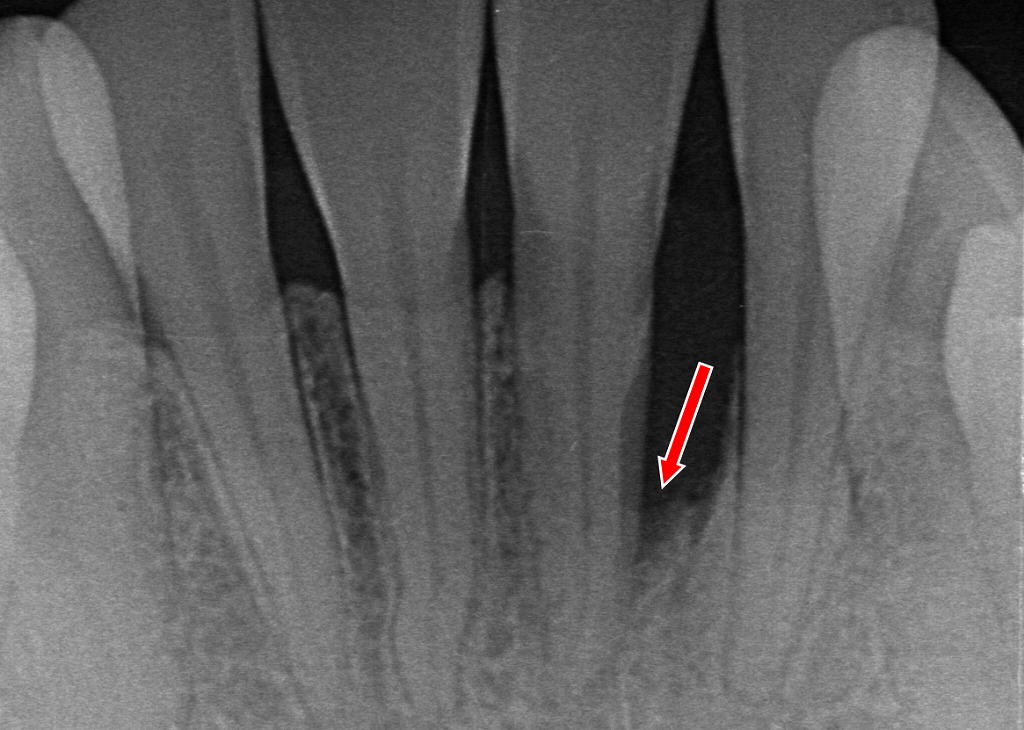 下顎1番にみられる垂直性骨吸収。条件が整えば、歯周組織再生療法で回復を目指せます。