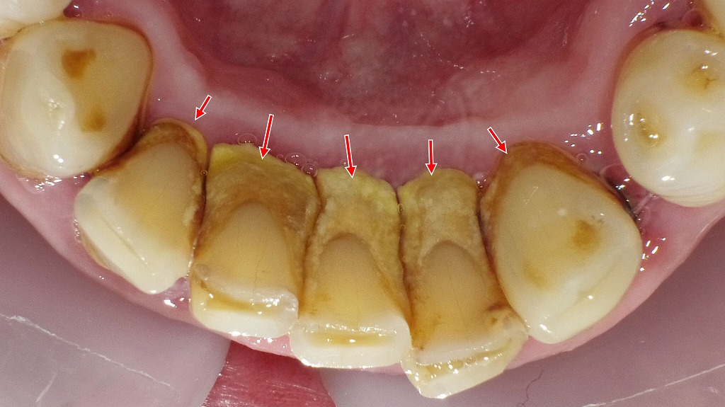 下顎舌側に大量に付着した歯石