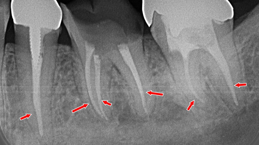 下顎5・6・7番の根管充填が適切に行われた状態