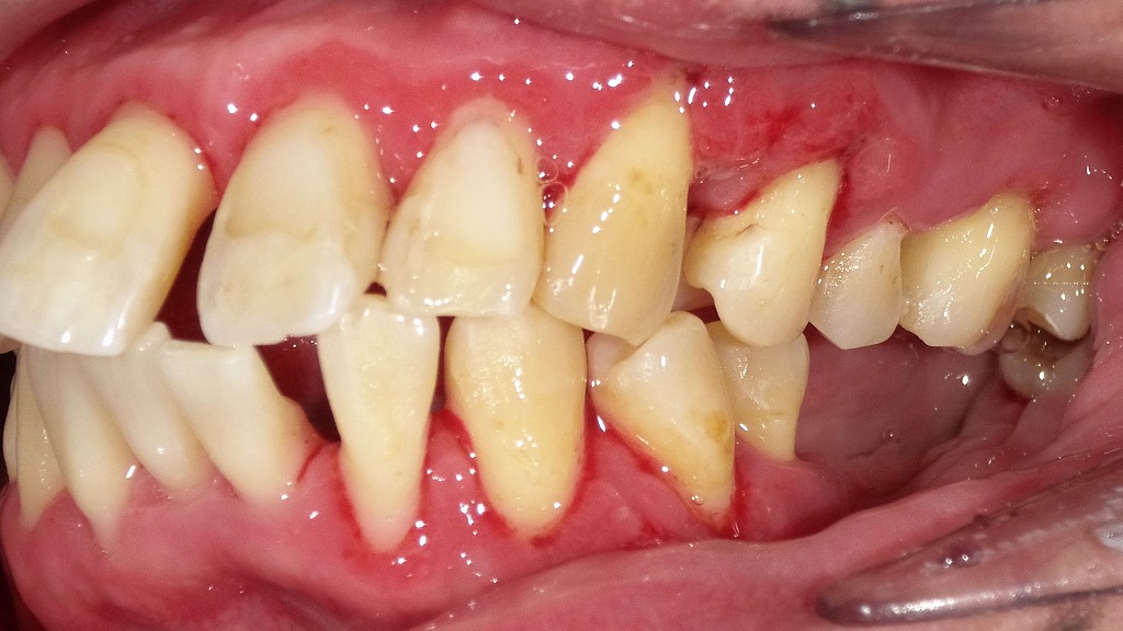 重度歯周病の当日歯石取り後:左側面