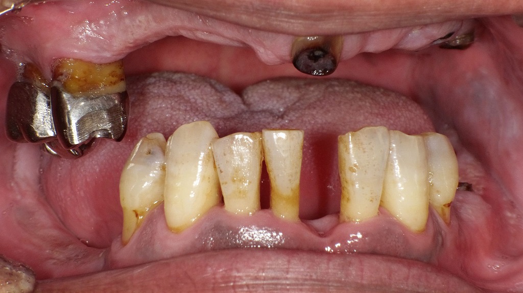 糖尿病と歯周病の悪循環 ― 互いに影響し合う全身とお口の健康