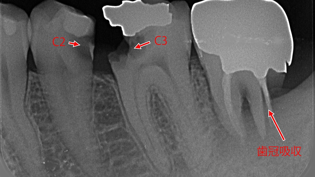 C2・C3虫歯と歯根吸収が確認できるデンタルレントゲン像
