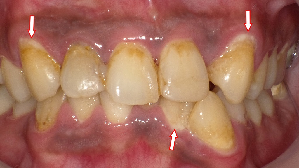 口腔バイオフィルム