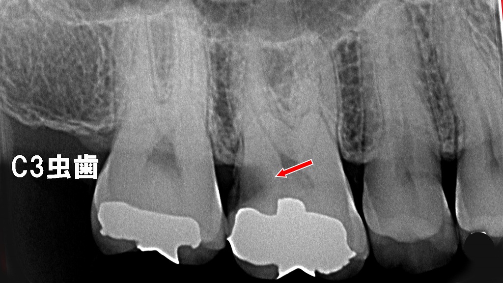 C3虫歯：歯髄に到達した重度う蝕（上顎6番遠心）