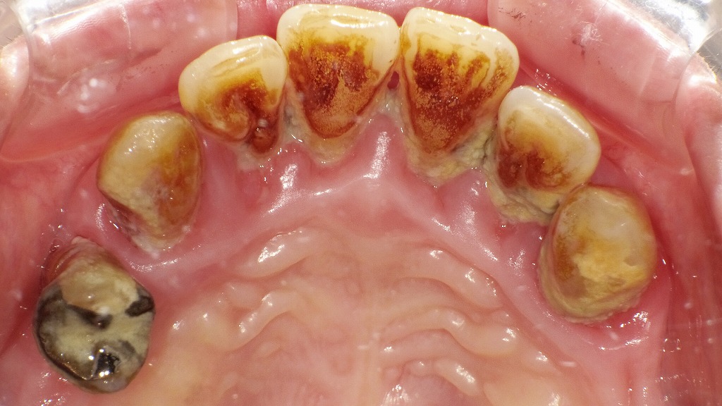重度歯周病の上顎前歯部（裏）