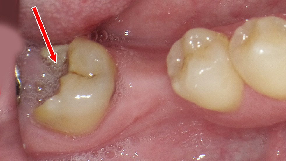 下顎7番のC3虫歯：赤い矢印の先に見える部分は、大きく欠けた歯の内部に歯肉（歯ぐき）が入り込んでいます。