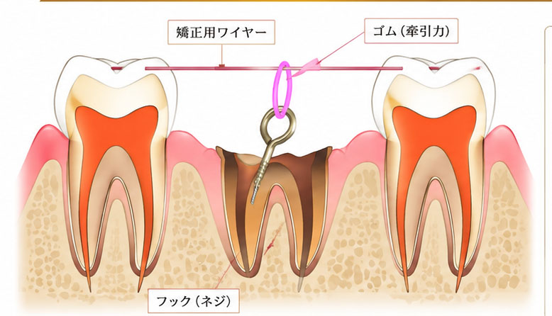 エクストルージョン法