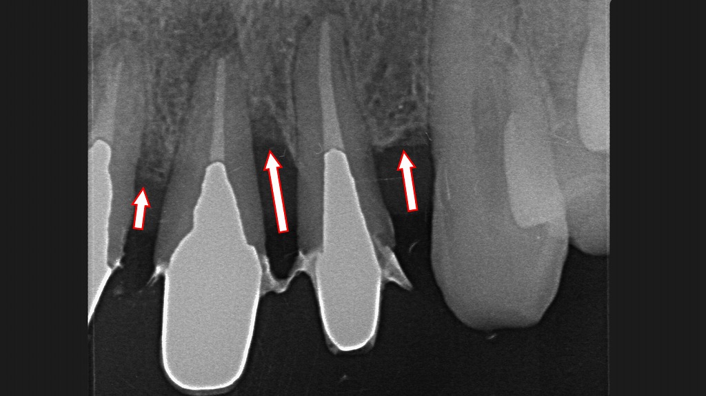 歯槽骨の吸収がある上顎前歯部のデンタルX線写真