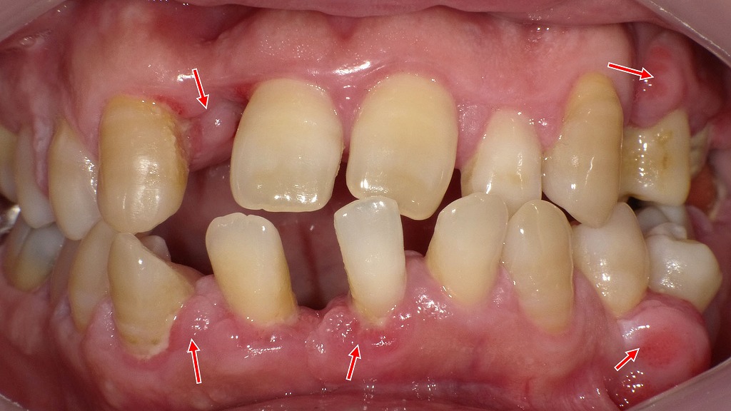 深い歯周ポケットが形成された状態 ― 重度歯周病の口腔内所見