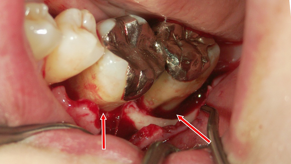歯周外科手術（フラップ手術）