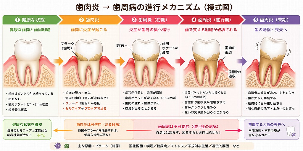 歯肉炎 → 歯周炎の進行メカニズム
