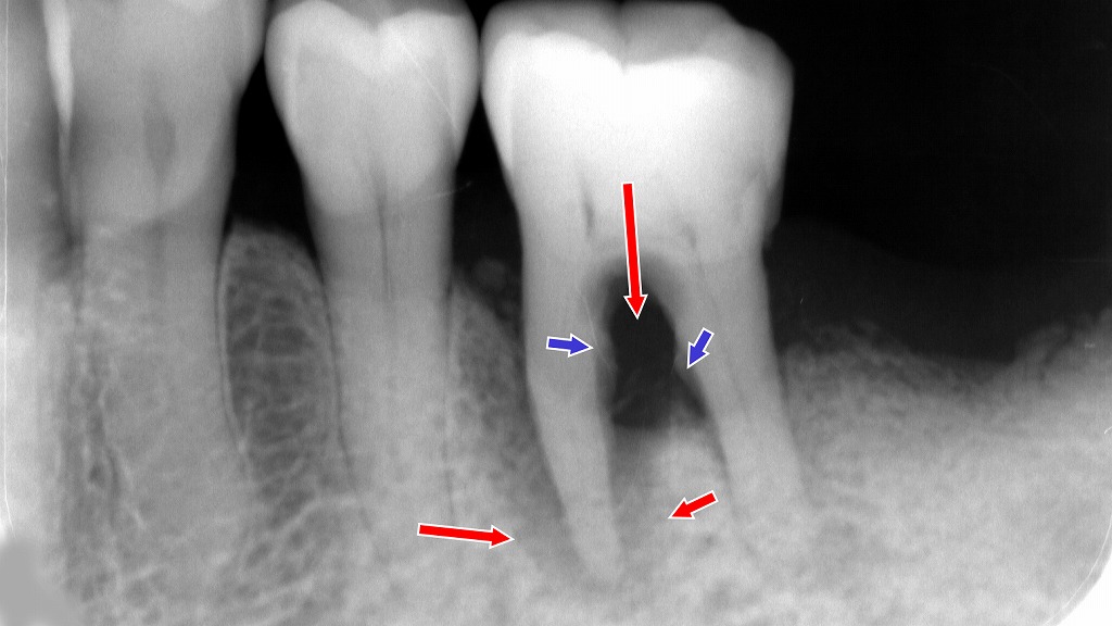 重度歯周病で大量の歯石が沈着（青矢印）し、骨吸収が進行した状態。