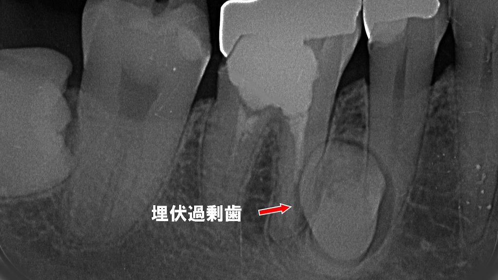 ６・５番部に認められる埋伏過剰歯のX線所見