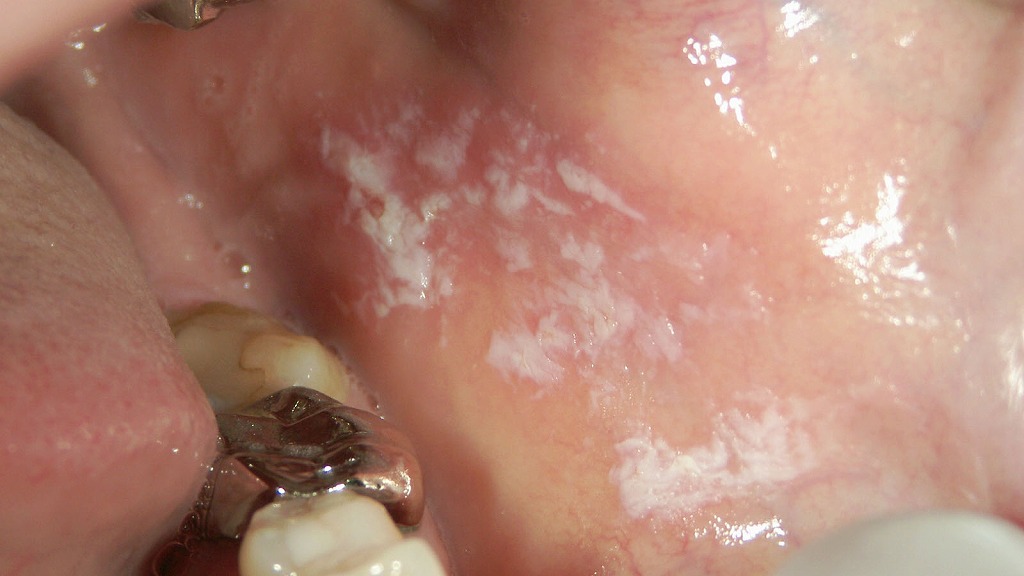 頬粘膜にみられる口腔扁平苔癬（こうくうへんぺいたいせん）