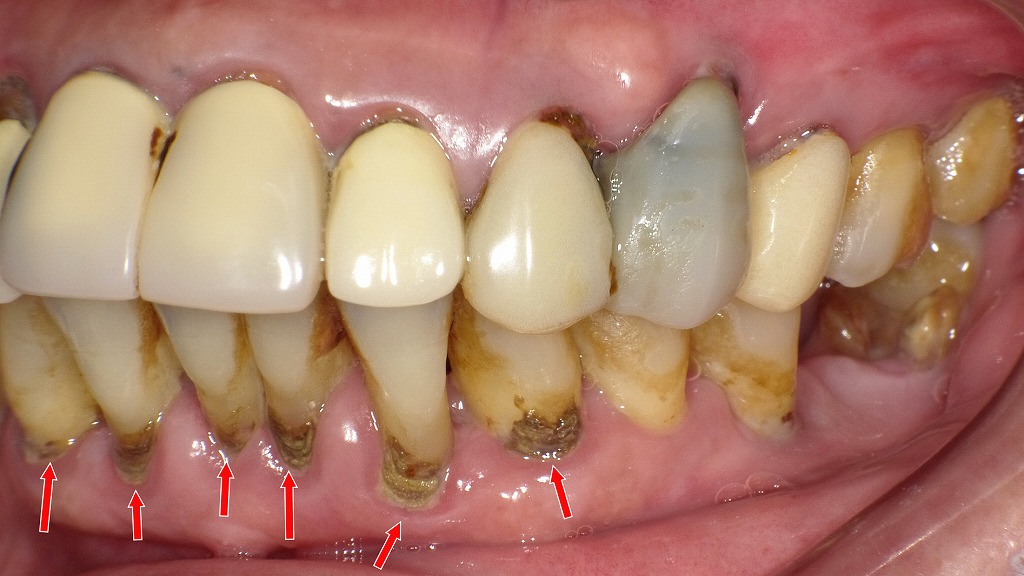 歯肉縁下歯石（黒い歯石）
