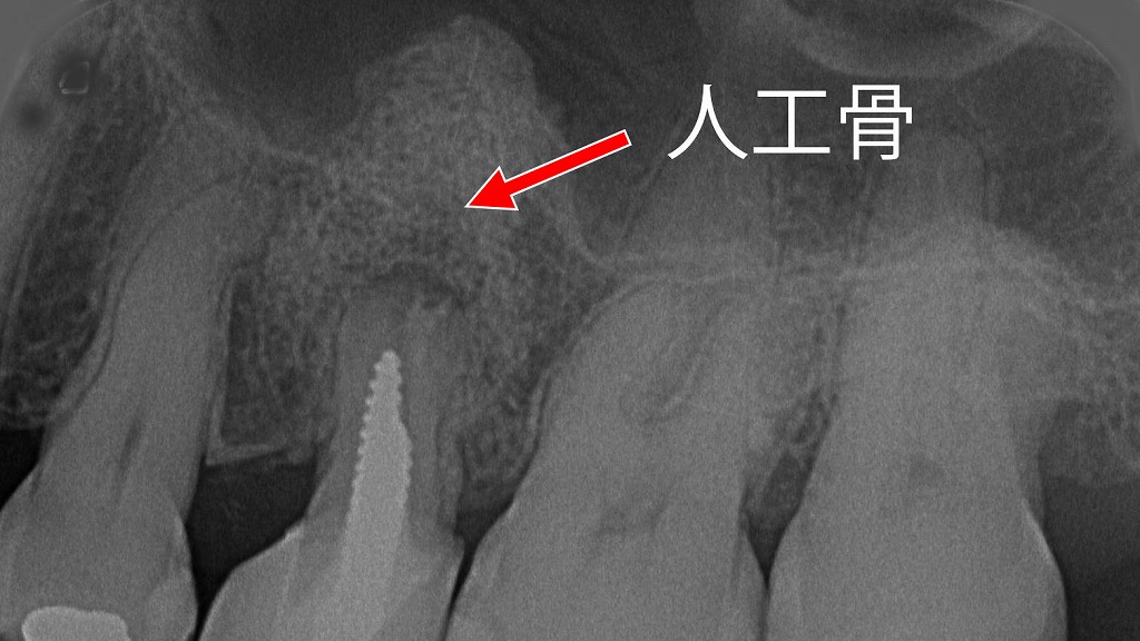 嚢胞摘出および外科的処置後の術後デンタルX線像。骨欠損部には人工骨を填入しており、周囲骨との境界に顆粒状の不透過像が認められる。骨再生の促進と欠損部の安定化を目的とした処置である。