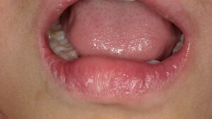 歯医者の麻酔後のトラブルと対策