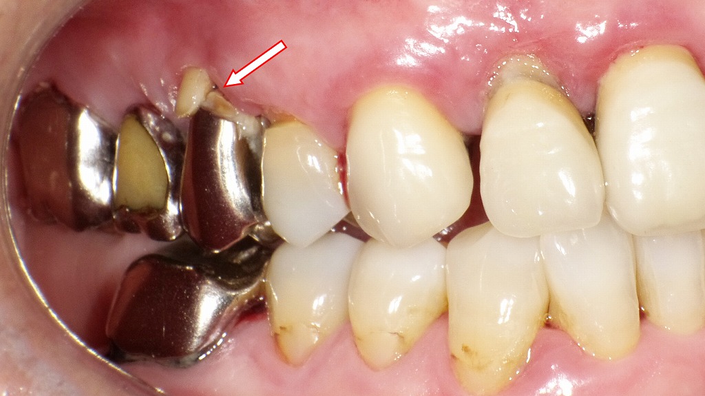 ブリッジの支台歯に二次カリエス
