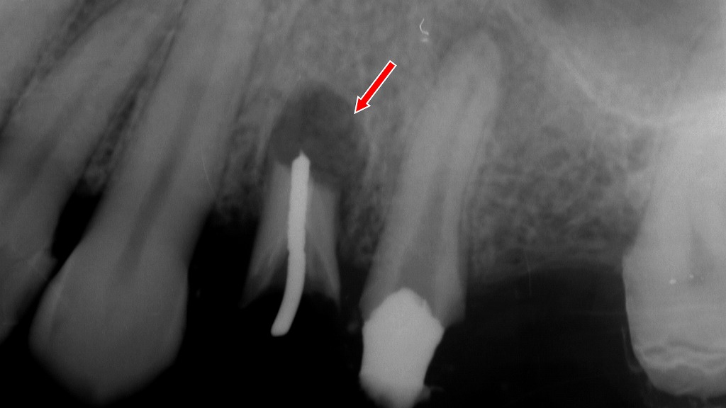 根管治療後に再発した根尖病変 ― 予後不良により抜歯となった症例
