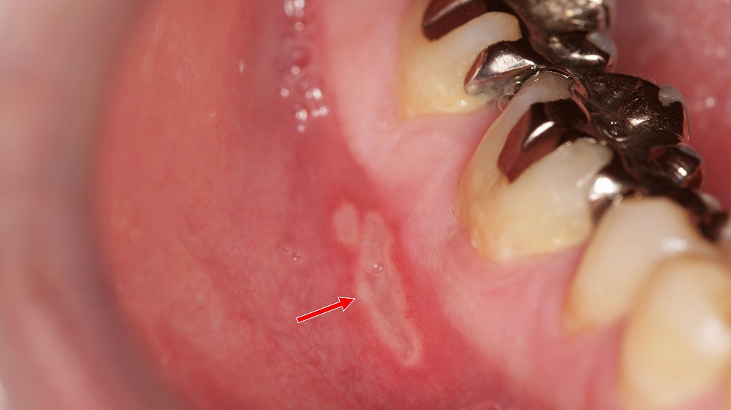 アフタ性口内炎｜白くえぐれた痛みを伴う口内トラブル