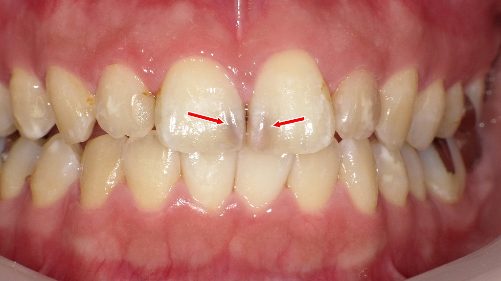 虫歯C2の見た目【前歯で穴はない】
