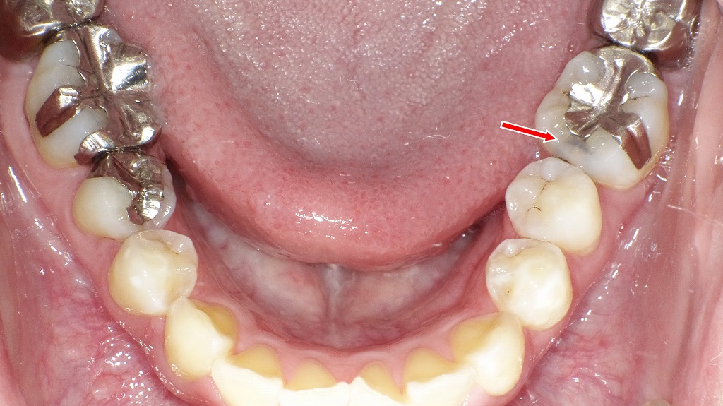 虫歯C2の見た目【奥歯で穴はない】