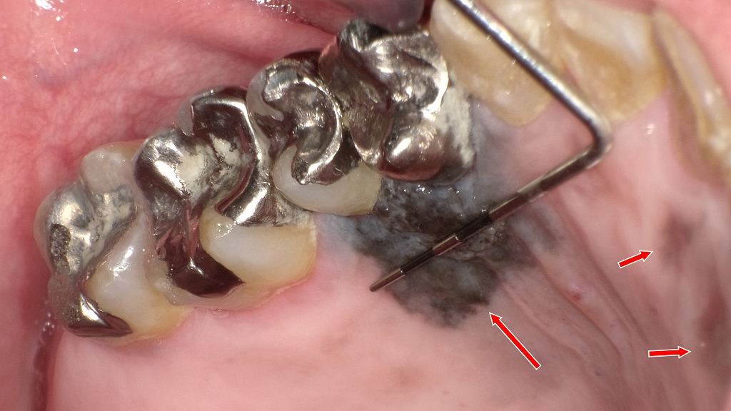 歯ぐきの黒いしみ：悪性黒色腫との鑑別が必要な症例