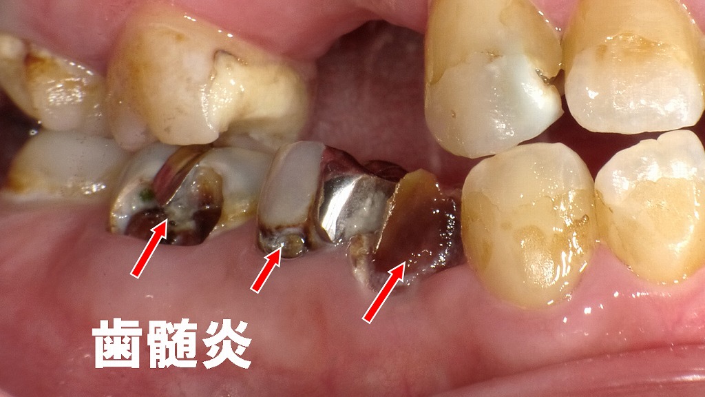 銀歯の下で進行した深い虫歯。強い痛みを伴い抜髄が必要な状態。
