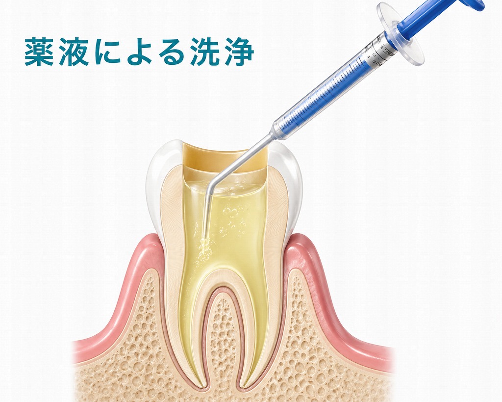 根管内の洗浄・消毒・貼薬