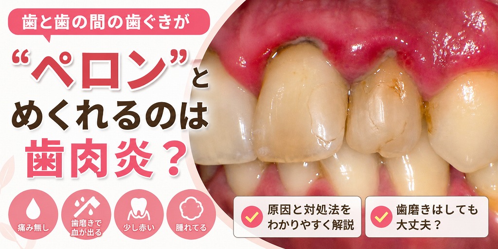 歯と歯の間の歯ぐきが「ペロン」とめくれるのは歯肉炎?