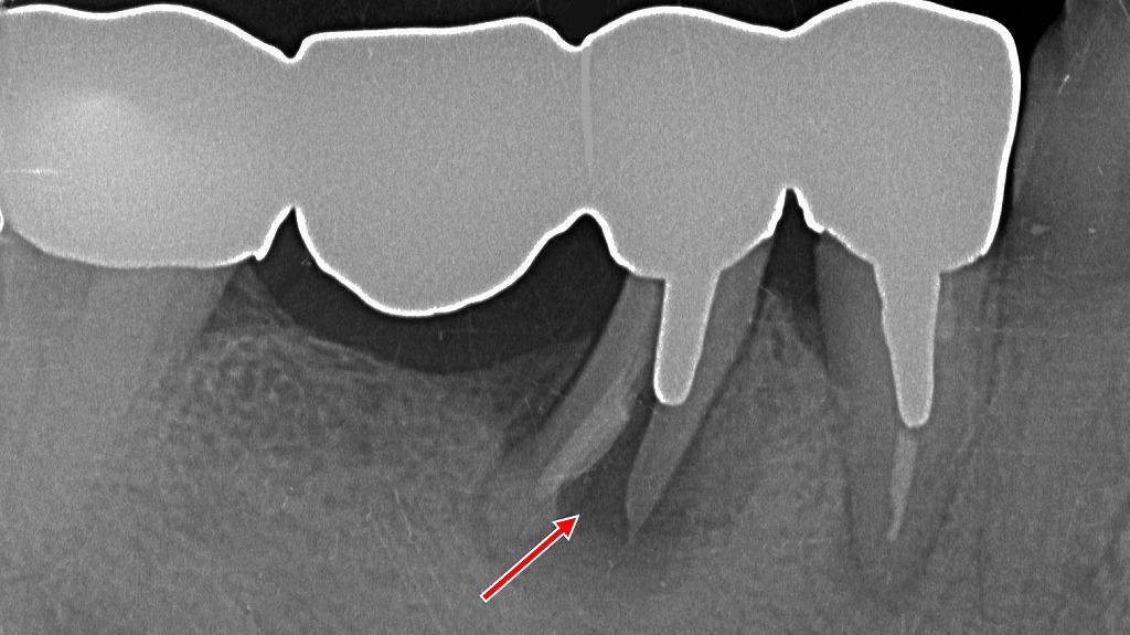 ⚠️ 4・5・6・7番ブリッジ|5番支台歯に歯根破折を認める症例