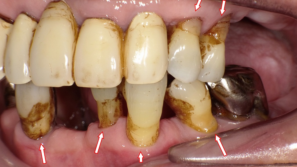 歯周病による歯肉退縮症例