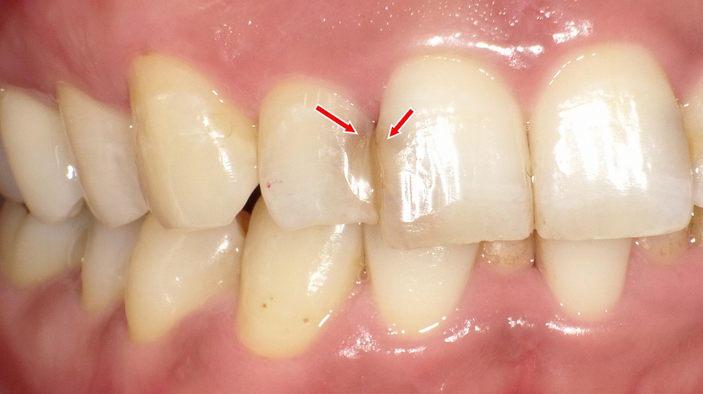 上顎１番・２番にコンポジットレジン充填、二次カリエスが認められる
