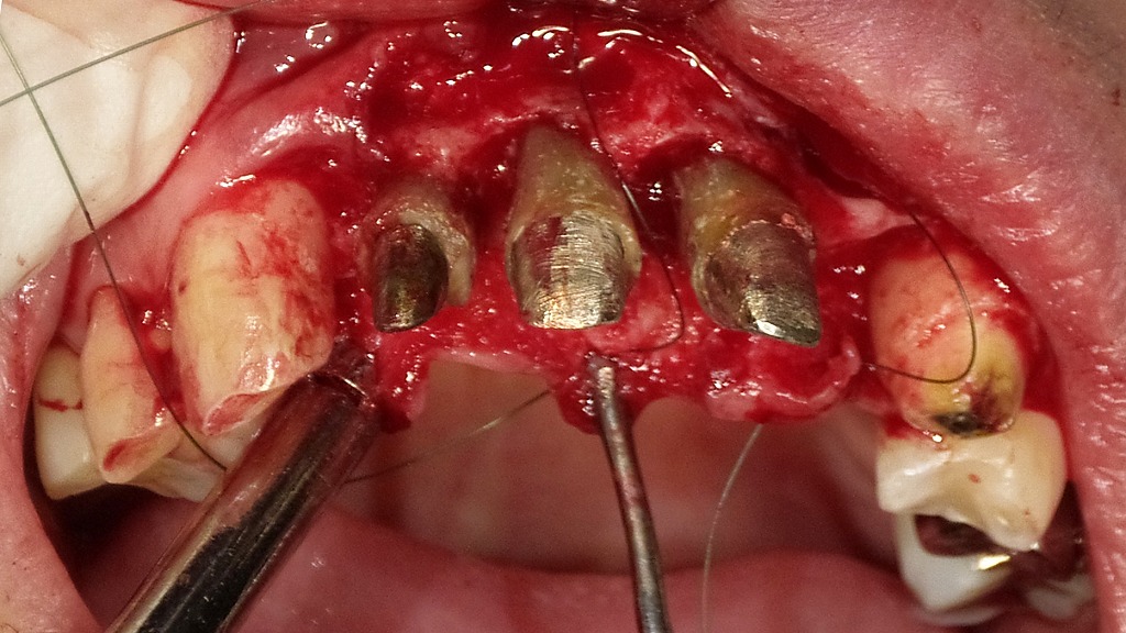 上顎前歯部における歯周外科手術（フラップ手術）