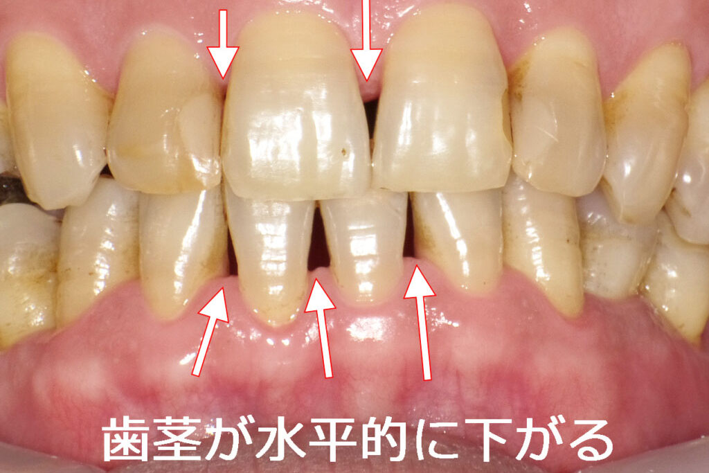 歯茎が水平的に下がる