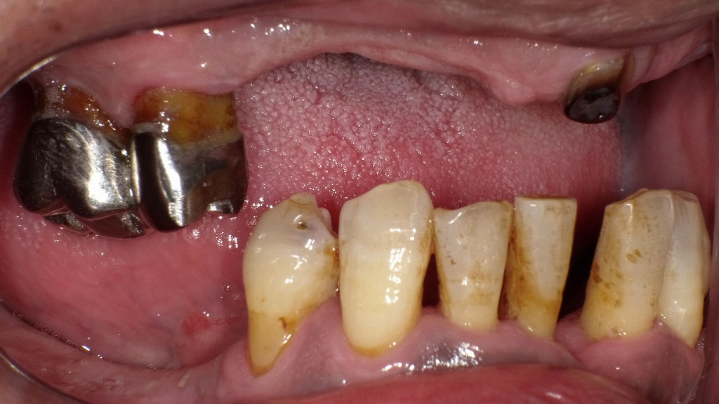 歯周病と糖尿病の深い関係 ― 口腔内の炎症が全身に及ぼす影響