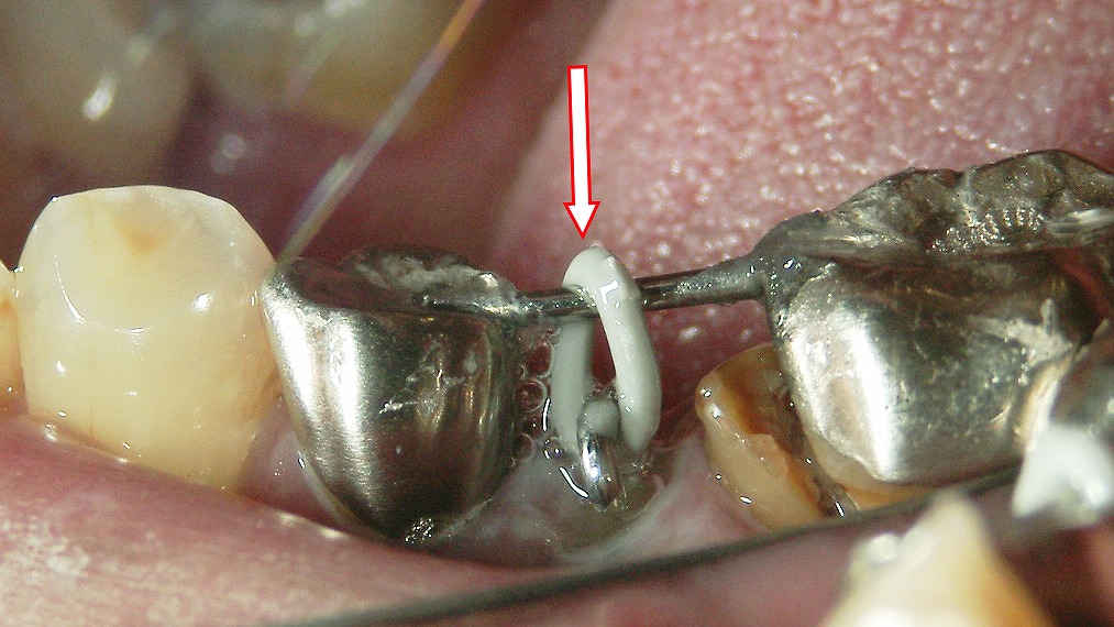 下顎第2小臼歯(5番)のエクストルージョン症例