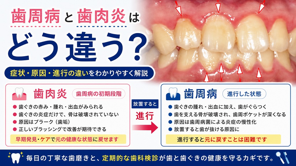 歯周病と歯肉炎はどう違う？